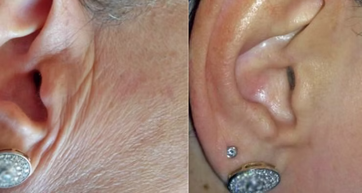 Banish Blemishes - reclaim your skin with Plasmage!