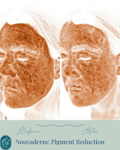 Nouvaderm Before and Afters