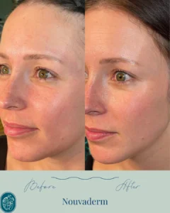 Nouvaderm Before and Afters