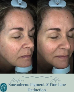 Nouvaderm Before and Afters