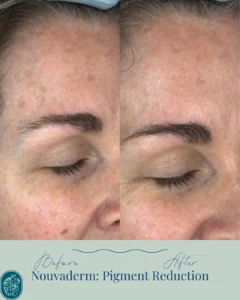 Nouvaderm Before and Afters