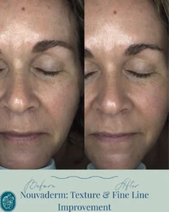 Nouvaderm Before and Afters
