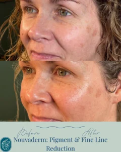 Nouvaderm Before and Afters