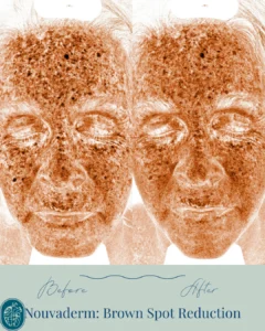 Nouvaderm Before and Afters