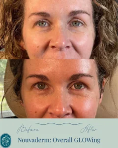 Nouvaderm Before and Afters