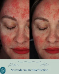 Nouvaderm Before and Afters