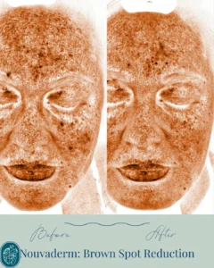 Nouvaderm Before and Afters