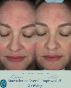 Nouvaderm Before and Afters