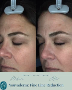 Nouvaderm Before and Afters