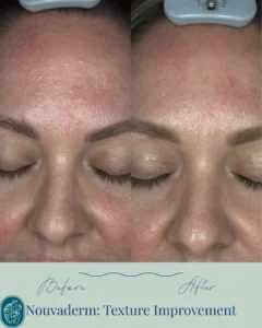 Nouvaderm Before and Afters