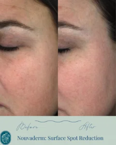 Nouvaderm Before and Afters