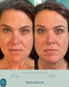 Nouvaderm Before and Afters