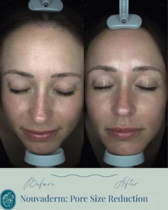 Nouvaderm Before and Afters