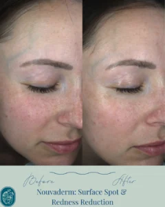 Nouvaderm Before and Afters