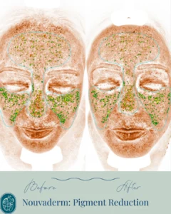 Nouvaderm Before and Afters