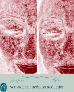 Nouvaderm Before and Afters