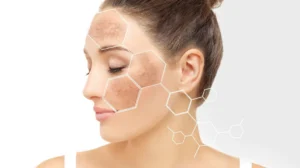 Close-up of a woman with hyperpigmentation on her cheek and forehead, overlaid with white hexagonal graphics.