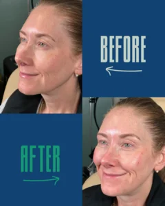 Before and after close-up images of a woman’s face showing skin texture and complexion improvements.