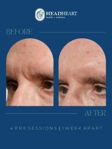 Before and after close-up images of a man's eye area showing skin improvement after four PRX sessions.