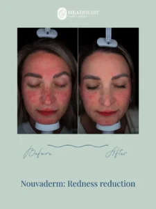 Before and after images of a woman's face showing reduced redness treatment results.