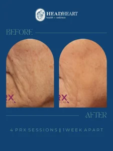 Before and after close-up images of facial skin showing reduced wrinkles and improved texture.