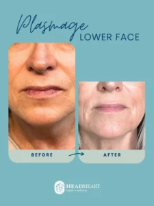 Before and after close-up images of the lower face showing reduced wrinkles post-Plasmage treatment.