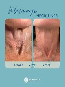 Before and after close-up images of a neck showing reduction in neck lines after Plasmage treatment.