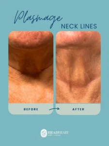 Before and after close-up images of a neck showing reduced neck lines after Plasmage treatment.