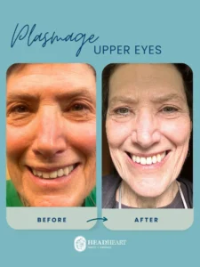 Before and after close-up photos of a woman's upper eyes showing treatment results.