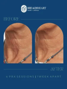 Before and after images of a neck showing reduced wrinkles after four PRX sessions one week apart.