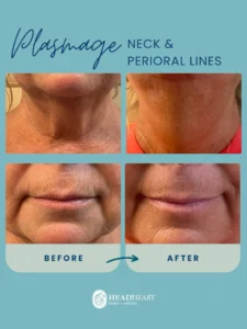 Before and after close-up images showing reduced neck and perioral wrinkles following Plasmage treatment.