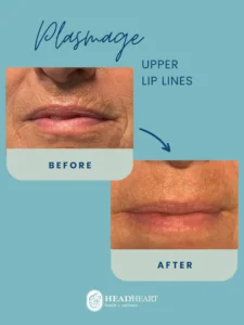 Before and after images of upper lip lines treatment with Plasmage, showing reduced wrinkles.