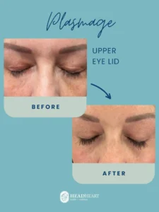 Before and after close-up images of a woman's upper eyelids showing skin improvement, labeled "Plasmage Upper Eye Lid.