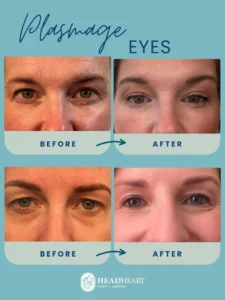 Before and after close-up images of eyes showing reduced wrinkles and smoother skin.