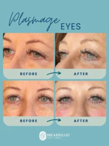 Before and after close-up images of a woman's eyes showing Plasmage treatment results.