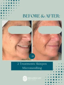 Before and after close-up images of a woman's cheek showing improved skin texture after two Skinpen microneedling treatments.