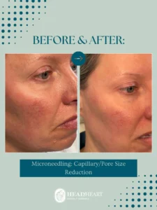Before and after close-up images of a woman's face showing reduced capillaries and pore size after microneedling treatment.