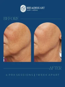 Before and after side-by-side images of a woman's lower face showing skin improvement after four PRX sessions.