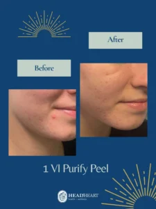 Before and after close-up images of a person's lower cheek showing acne improvement.