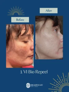 Before and after close-up images of a woman's face showing skin texture improvement after one VI Bio Peel treatment.