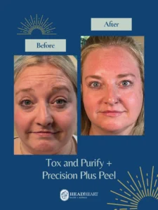 Before and after close-up photos of a woman showing facial skin improvement after Tox and Purify plus Precision Plus Peel treatment.
