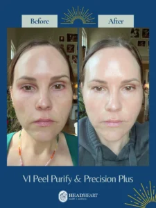 Before and after close-up images of a woman's face showing improved skin clarity and smoothness after VI Peel treatment.