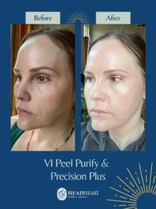 Before and after comparison of a woman's face showing improved skin clarity and brightness.