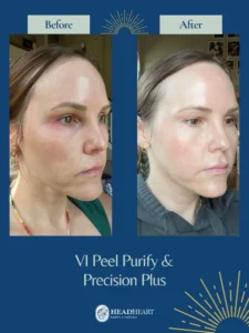 Before and after comparison of a woman's facial skin showing reduced redness and improved clarity.