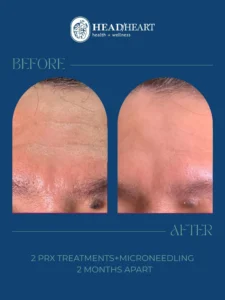 Before and after close-up images of a forehead showing skin improvement after treatments.