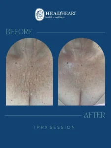 Before and after close-up images of a chest area showing skin texture improvement after one PRX session, with visible reduction in wrinkles and enhanced smoothness, presented on a blue background with Head/Heart health + wellness logo.
