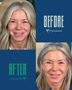 Before and after close-up images of a middle-aged woman with blonde hair, showcasing facial improvements.