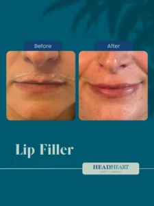 Before and after close-up images of a person's lips showing lip filler results.