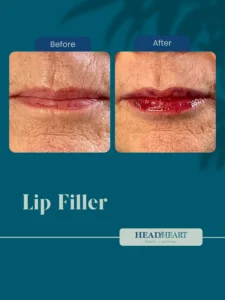 Before and after close-up images of lips showing lip filler results, with visible skin texture.