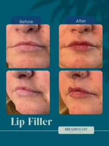 Before and after close-up images of a woman's lips showing enhanced fullness and gloss from lip filler treatment.